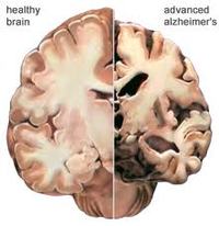Alzheimer - effetti sul cervello