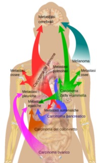 Tumore al polmone - metastasi