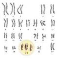 Sindrome di Down - cromosomi